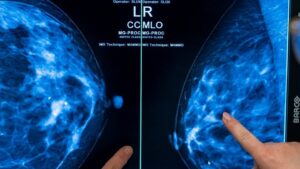 Krankenkassen zahlen ab sofort Mammografie für Frauen bis 75